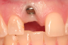 dental-implant-before