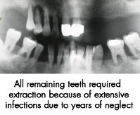 All remaining teeth required extraction due to extensive infections due to years of neglect