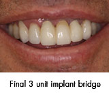 final 3 unit dental implant