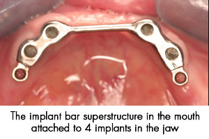 Implant lower jaw