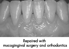 Mucogingival surgery after
