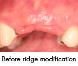 ridge-modification-1