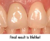 final results of dental implant look lifelike!