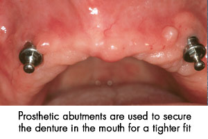 Prosthetic abutments are used to secure the denture in the mouth for a tighter fit