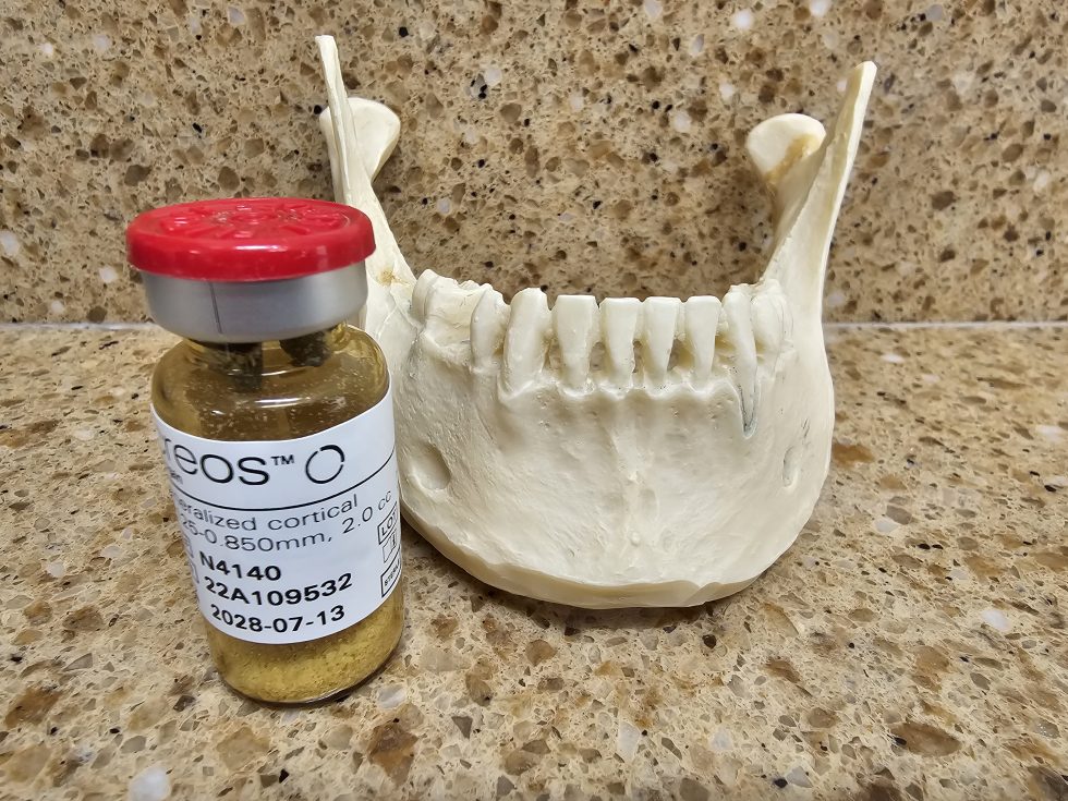 How Bone Graft And Membrane Can Transform Your Smile Dr. Caplanis