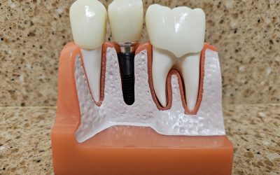Dental Implants Will Help Give You That Smile You Always Wanted