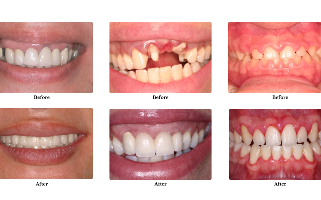 teeth-2-dr-caplanis